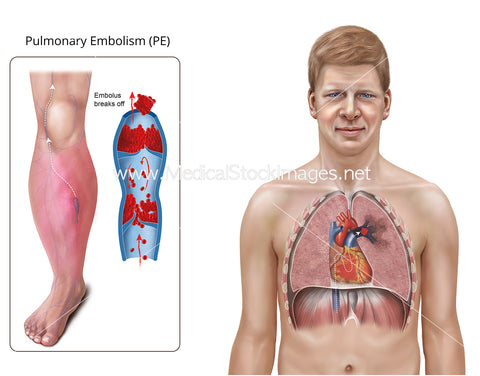 Pulmonary Embolism (PE) Explainer Illustration