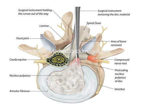 A Diagram Showing a Disc Bulge Being Removed-Labelled