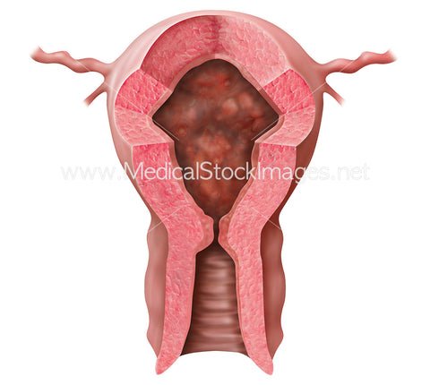 Hyperplasia Polypoid Tendency in Uterus
