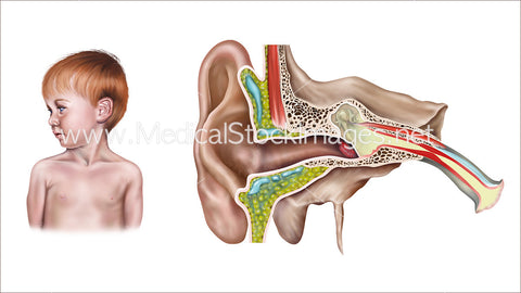 Otitis Externa of the Ear