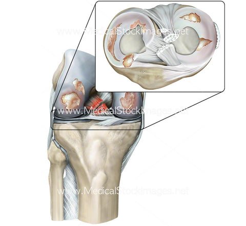 Knee joint showing damage from rheumatoid arthritis and the meniscus