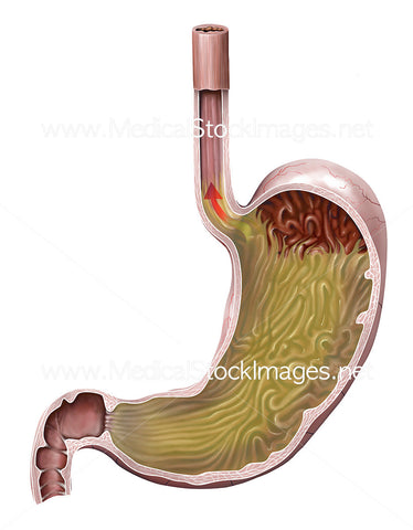 Esophagus GERD & Stomach Image