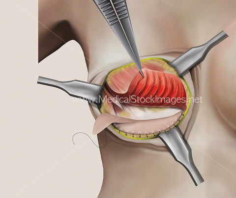 Illustration of the First Stage of Breast Surgery involving Soft Tissue Support