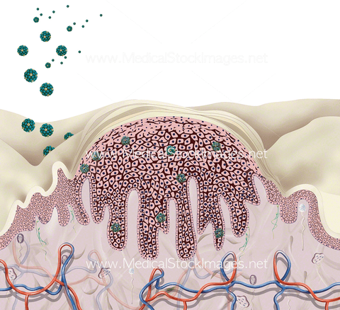Anatomy of a Skin Wart - Incoming Virus
