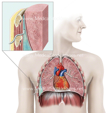 Pleural effusion (Abnormal fluid in lungs)