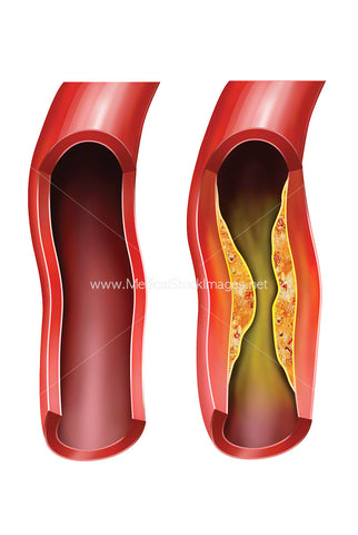 Arteriosclerotic Vascular Disease or ASVD
