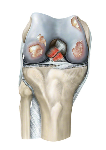 Rheumatoid Arthritis of the Knee Joint Plus Torn Cruciate Ligament