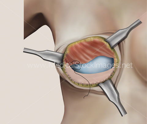 Illustration of the Second Stage of Breast Surgery involving Soft Tissue Support