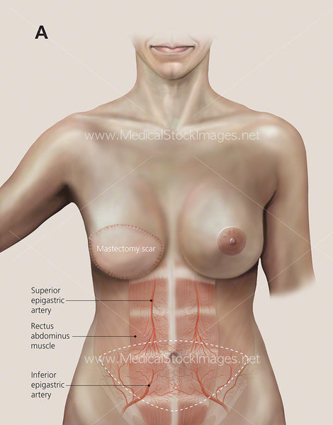 Breast reconstruction with abdominal tissue flap