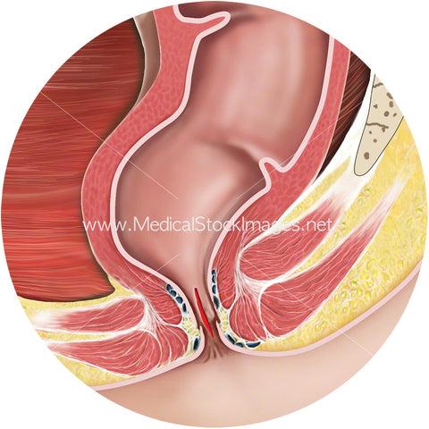 Anal Fissure