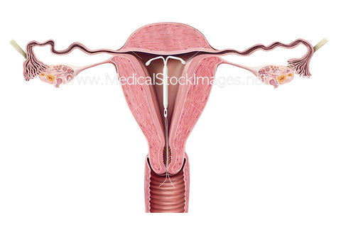 Uterus with IUD