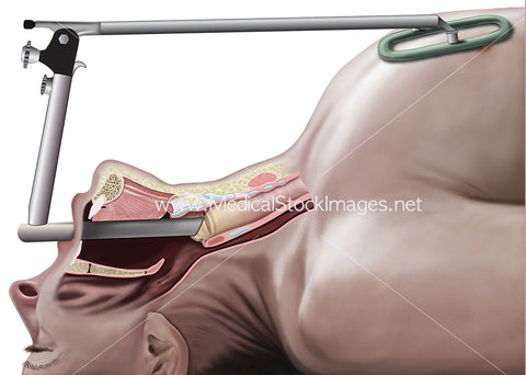 Laryngoscopy Procedure