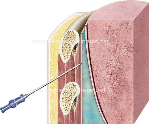 Pleural Biopsy Procedure