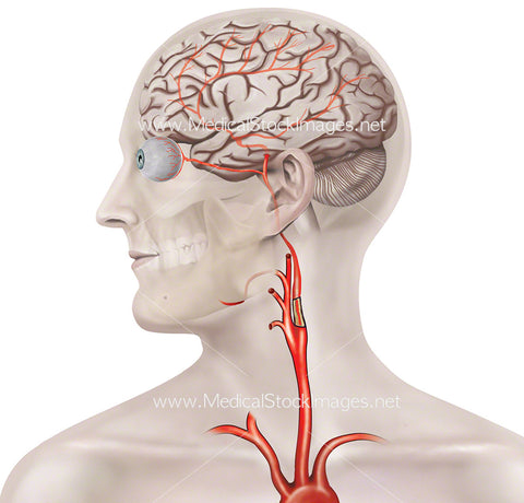 Blockage in the Carotid Artery