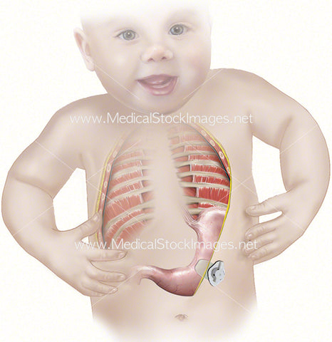 Gastrostomy Procedure Infant