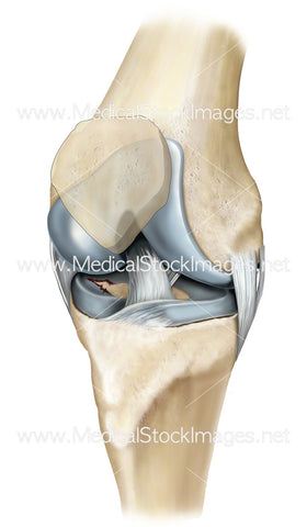Knee Joint with Damaged Cartilage