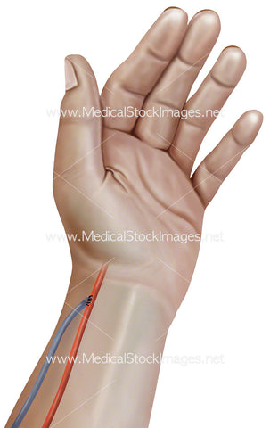 Fistula Ligated Wrist