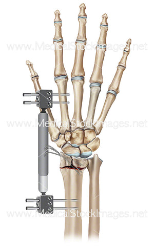External Fixation Wrist Fracture