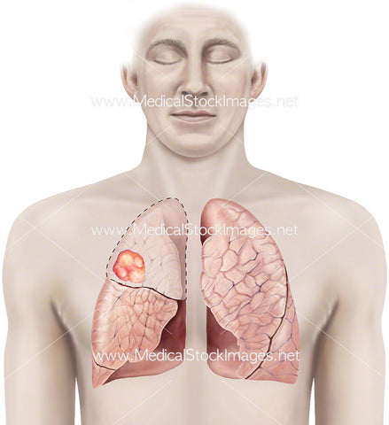 Tumour in the Right Lung