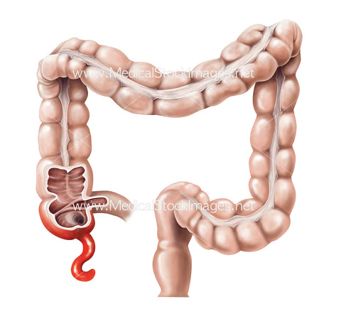Bowel and Inflamed Appendix with Cut Through