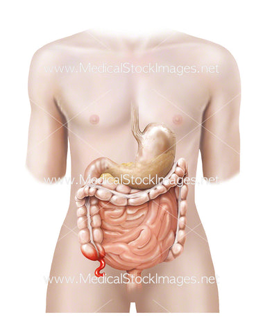 Androgynous Figure with an Inflamed Appendix