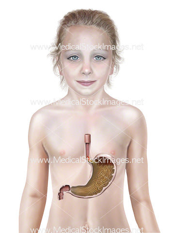 Child with Stomach GERD