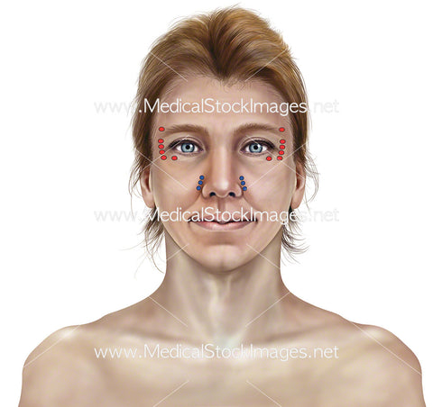 Botox Injection Points into the Skin and Underlying Muscle