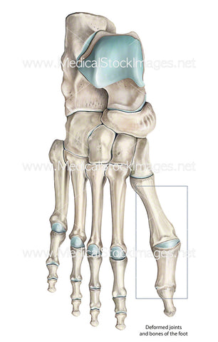 Deformed Toe Bones and Joints