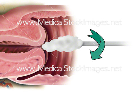 Smear Test (Cervical Screening)