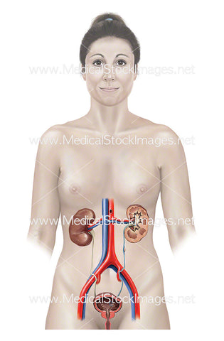 Female Figure Showing Urinary System and Kidney Stones