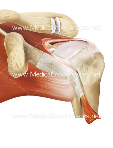 Massive Tear in the Supraspinatus Tendon