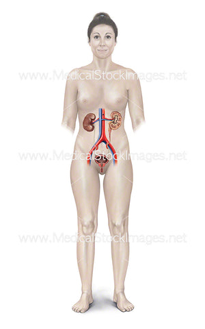 Female Figure with Blockage in Ureter of Left Kidney