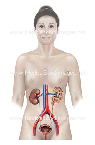 Female Figure Shown with Blockage in Ureter of Left Kidney