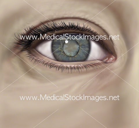 Hypermature Age-Related Cortical Nuclear Cataract