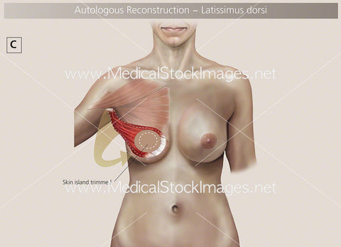 Autologous Reconstruction – Surgery Step C - Labelled