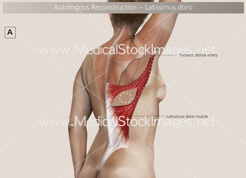 Latissimus Dorsi or Myocutaneous (LD) Flap Surgery Labelled