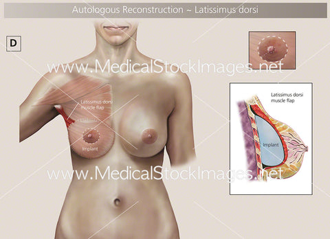 Autologous Reconstruction – Surgery D - Labelled