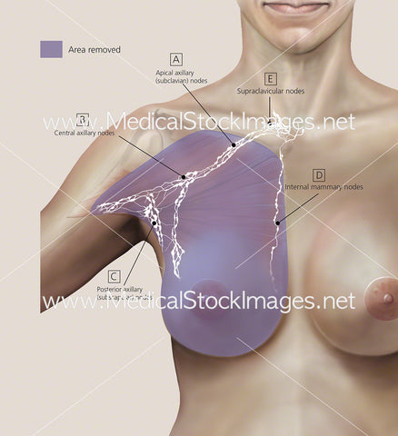 Radical Mastectomy Colour Background