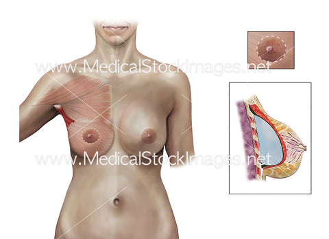 Latissimus Dorsi or Myocutaneous (LD) Flap Surgery Anterior View with Call Outs No Labels