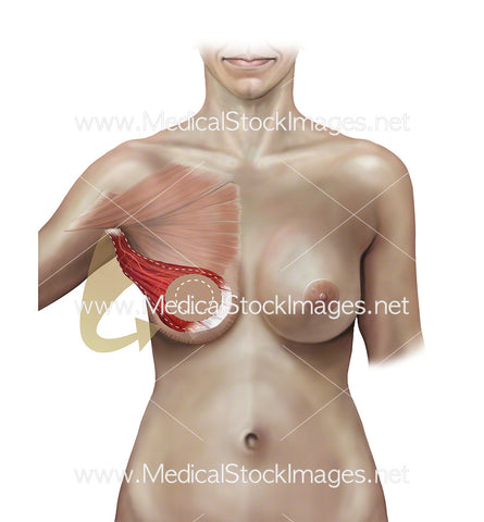 Stage C Autologous Breast Reconstruction