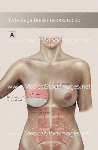 Two Stage Breast Reconstruction – First Stage - Labelled