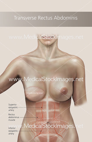 Transverse Rectus Abdominis Showing Mastectomy Scar (TRAM FLAP) - Labelled