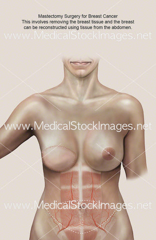 Mastectomy Scar After Surgery (TRAM FLAP)