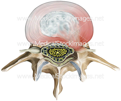 Ruptured Disc of Lumbar Vertebra