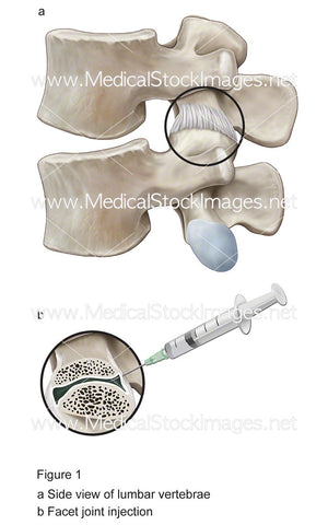 Lumbar Facet Joint Injection