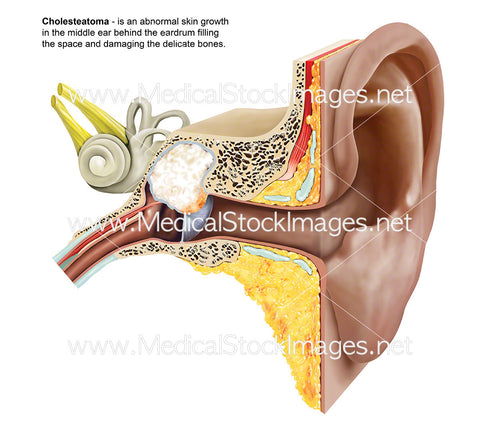 Cholesteatoma of the Middle Ear - Labelled