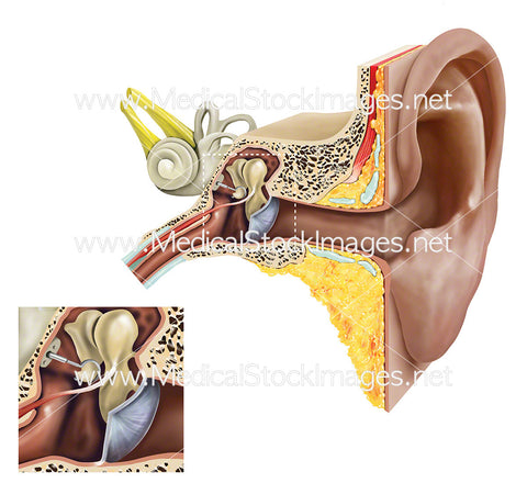 Stapedectomy of the Stapes of the Ear with Call Out