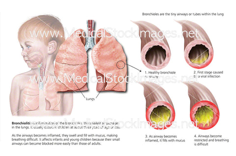 Bronchiolitis in Child showing Inflammation of the Bronchioles