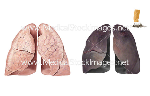 Healthy Lungs and Smoker’s Lungs – No Labels