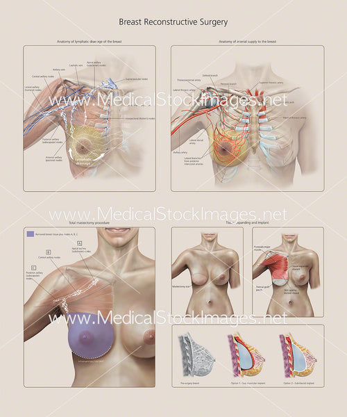 Breast reconstruction - series—Aftercare: MedlinePlus Medical Encyclopedia